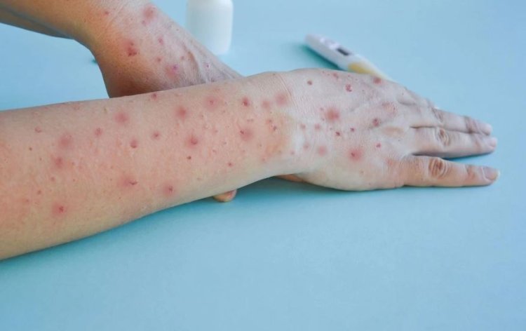 Odisha on high alert after India's first suspected case reported for Mokneypox